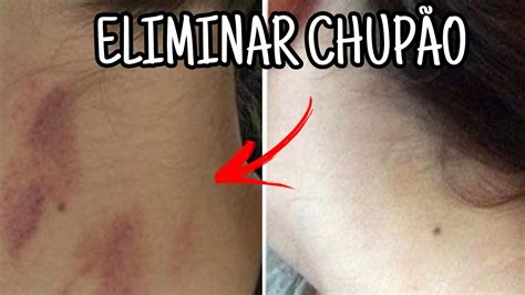 chupão no peito|Como tirar chupão: 8 truques simples para remover。